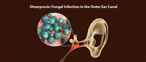 Otomycosis Ear Fungal Infection Overview Symptoms And Treatments