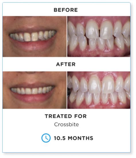 Suresmile Before And After See The Difference Suresmile Usa