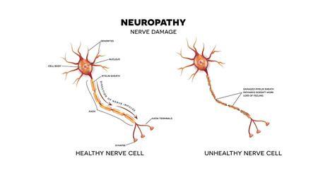 Diabetic Neuropathy Ailments And Conditions Ecpc