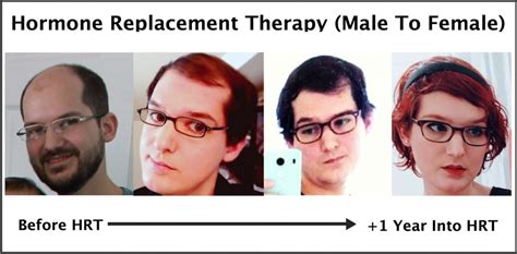 Exactly How Trans Hormone Replacement Therapy Regrows Hair Photos