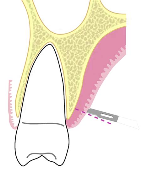 Controlled Palatal Harvest Cph Technique For Harvesting A Palatal