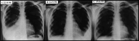 Figure From Development Of Contralateral Pleural Effusion During