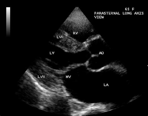 Parasternal Long Axis View Showing The Concentric Lvh Left Ventricular