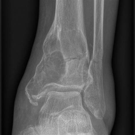 Anteroposterior Ap Radiograph Of Left Ankle Showing A Transverse