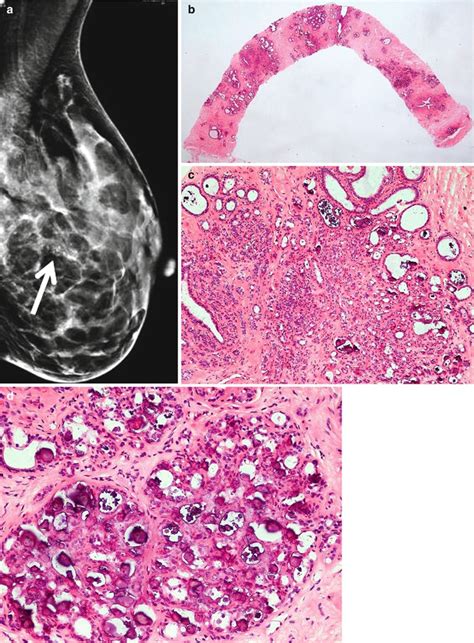 Pathology Of Benign Breast Lesions Radiology Key