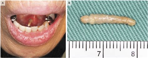 Passage Of A Sialolith Nejm