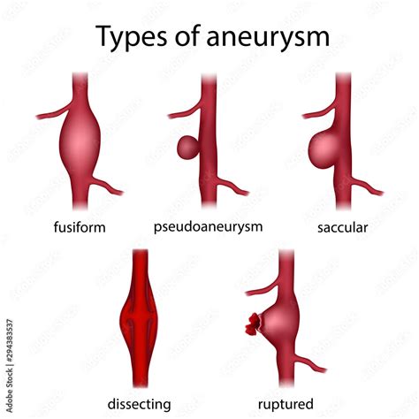 Types Of Aneurysm Fusiform Pseudoaneurysm Saccular Dissecting Ruptured Medical Anatomy