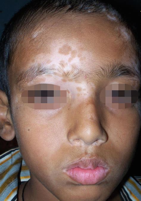Progressive Depigmented Macules On Face And Hands In A Child Plastic