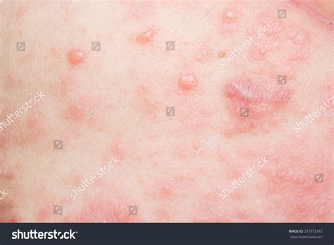 99 Vesicular Rash Images Stock Photos And Vectors Shutterstock