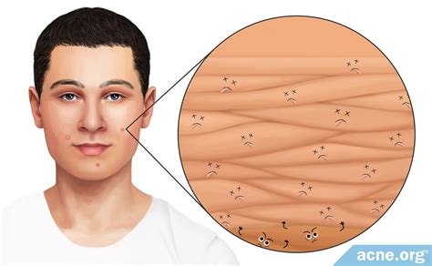 Acne In Depth How Dead Skin Cell Accumulation Can Lead To Acne