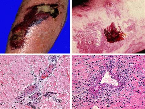 Actitud Diagnóstica Ante La Sospecha De Vasculitis