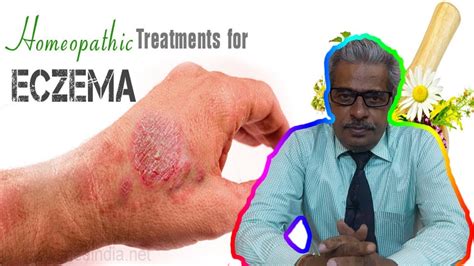 Eczema Dermatitis Treatment In Homeopathy By Dr Ps Tiwari Youtube