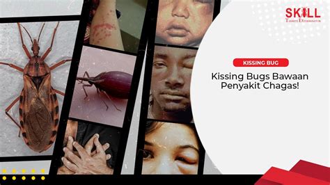 Kissing Bugs Bawaan Penyakit Chagas Youtube