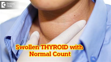 Swollen Thyroid But Blood Test Normal What Does It Mean Dr