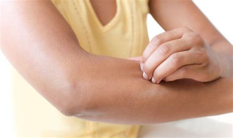 Eczema Treatment Acupressure May Alleviate Symptoms Uk