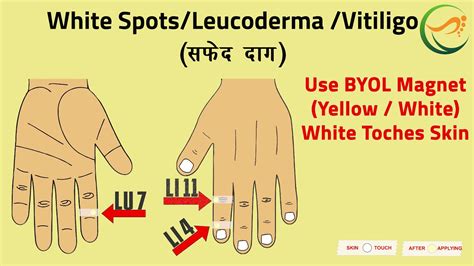 White Spot Leucoderma Vitiligo सफेद दाग Curativetherapy