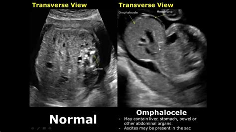 Fetal Bowel Ultrasound Normal Vs Abnormal Image Appearances Intestine