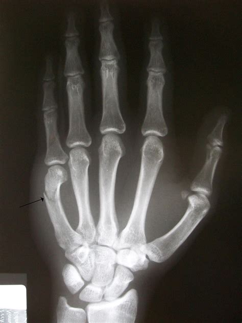 Fileboxers Fracture Wikimedia Commons