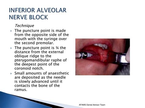 Inferior Alveolar Nerve Block Ppt