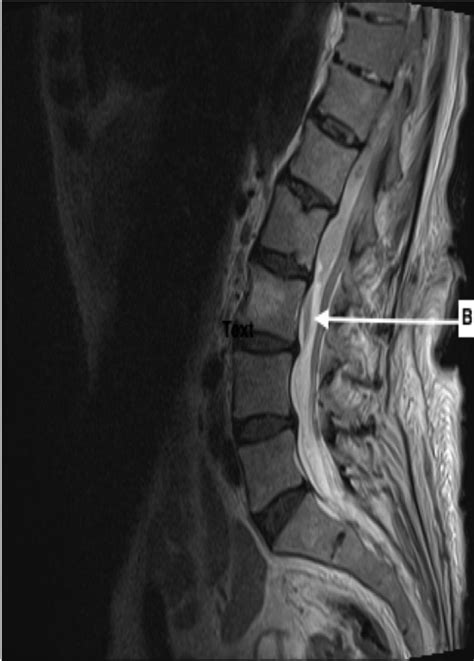 Cureus Spontaneous Spinal Epidural Hematoma Secondary To Rivaroxaban