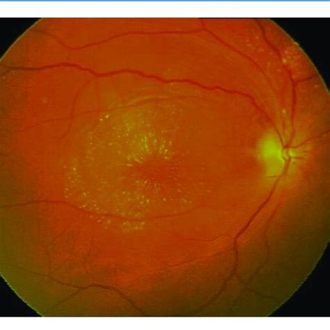 Fundoscopy In Right Eye Revealing Macular Oedema With Star Formation