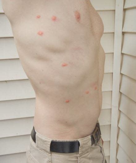 Top Pictures Of Chigger Bites Explained Pest Professional Services