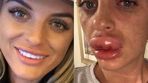 Woman Nearly Lost Top Lip After Getting Botched Fillers At Botox
