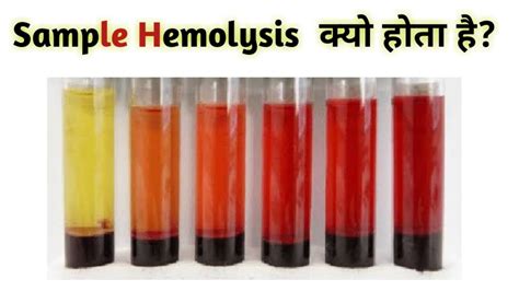 What Is Hemolysis Cause Of Hemolysis Youtube
