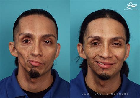 parry romberg syndrome before and after photos sage plastic surgery