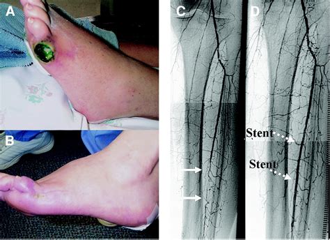 Primary Stent Supported Angioplasty For Treatment Of Below Knee