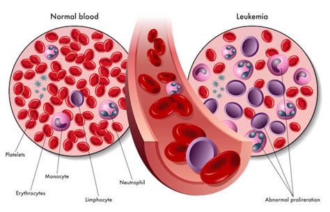 Leukaemia Causes Symptoms And Treatment Clicks Health Hub