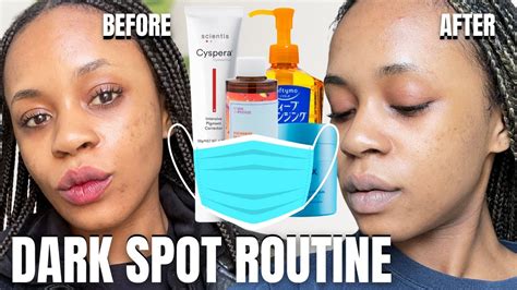 Fading Hyperpigmentation From Mask Acne Scars Black Skin Youtube
