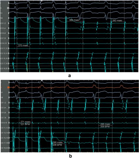 During Macro Reentrant Atrial Tachycardia With A Tcl Ms Atrial