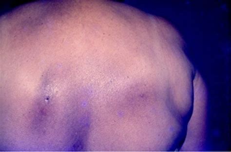 Notalgia Paresthetica Hyperpigmented Macules In Scapular Areas Asso