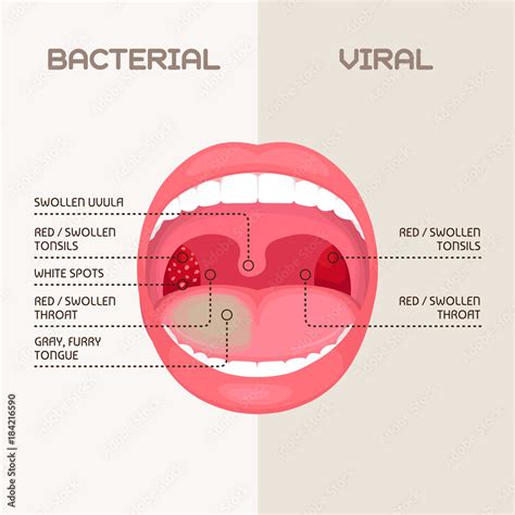 Vector Illustration Of A Throat Bacterial And Viral Infection Tonsils