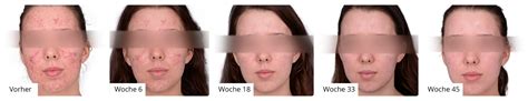 Duac akne gel für akne mit rötungen, ausschlag, jucken, trockene haut, geschwollenes gesicht, schälen der haut. Aknebehandlung - Vorher-/Nachherbilder - Dr. med. Natalie ...