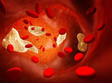 Thrombosis Causes And Treatment