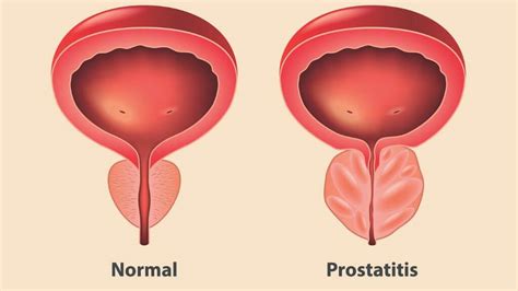 Trouble Urinating Causes Diagnosis And When To See Your Doctor 1MD