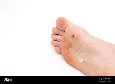 Wart Human Hi Res Stock Photography And Images Alamy