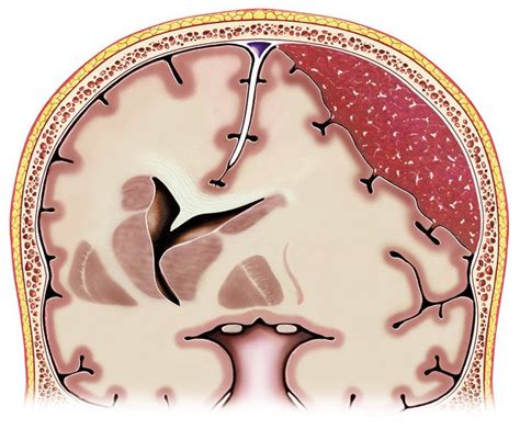 Subdural Hematoma Guide Causes Symptoms And Treatment Options