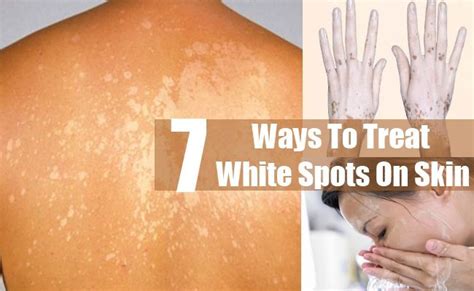 7 Ways To Treat White Spots On Skin Skin Spots Diy Bath Products