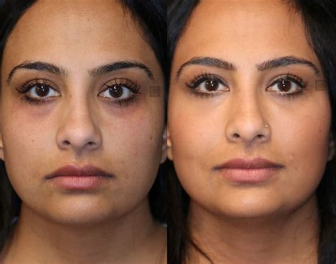 Procedure To Remove Under Eye Bags Save Multiaceros Cl