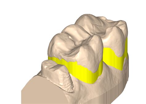 Polygonica Using Polygonica For Dental Modelling