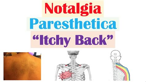 Notalgia Paresthetica “itchy Back” Causes Risk Factors Symptoms