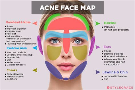 Acne Face Map What Is Your Acne Trying To Tell You