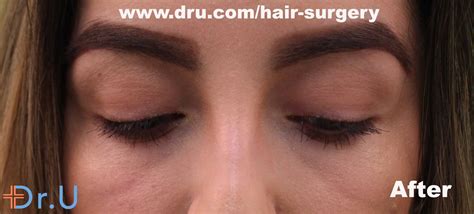 Video The Veelashe Pubic Hair Eyelash Transplant Surgery By Dr U Los Angeles