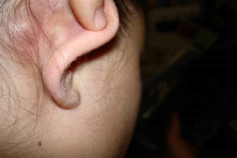 7 Possible Causes Of Painful Lump Behind Ear New Health Advisor