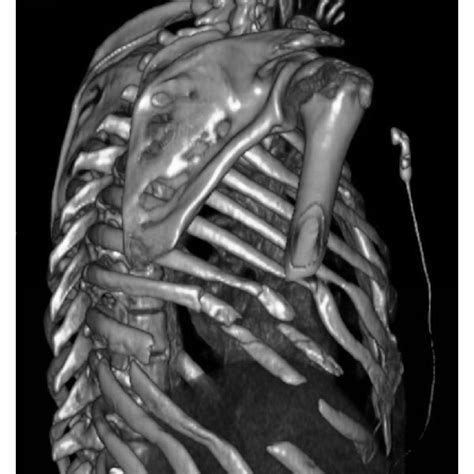 Surgical View After Flail Chest Reconstruction With Stracos Only One