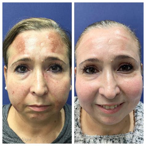 Before And After Medical Spa Pictures Lexington Ky Bemedispa