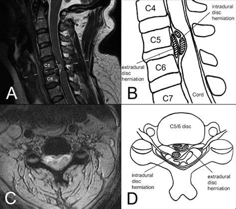 A C Spine Mr Sagittal Image Shows C Central Herniated Disc With